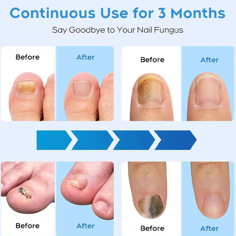 Fungal Nail Laser Device Repair Foot Care